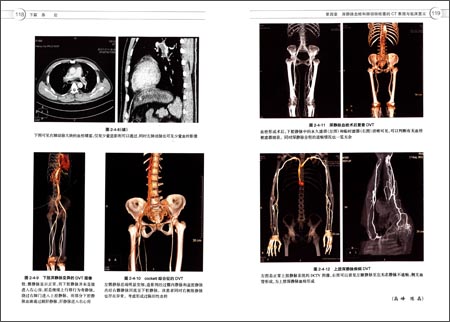 《静脉血栓栓塞症诊断与治疗》 张福先, 王深明