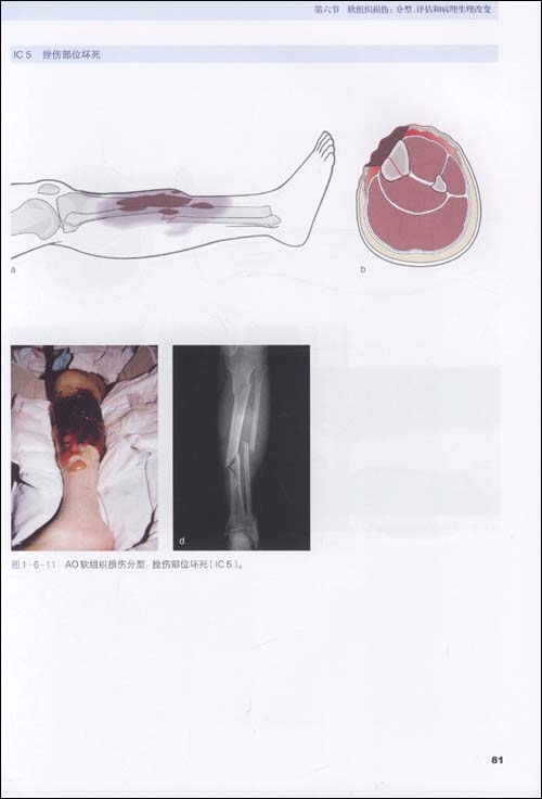 骨折治疗的AO原则(第2版)\/王满宜-图书-亚马逊